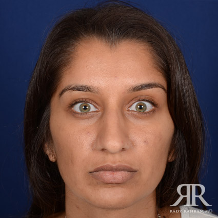 Ethnic Rhinoplasty