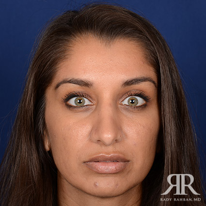 Ethnic Rhinoplasty