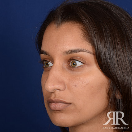 Ethnic Rhinoplasty