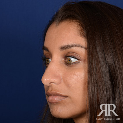 Ethnic Rhinoplasty