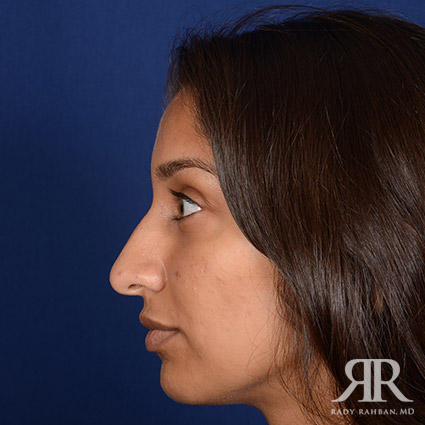 Ethnic Rhinoplasty