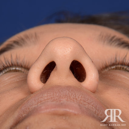 Ethnic Rhinoplasty