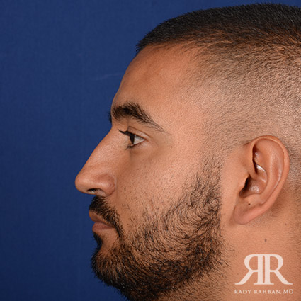 Ethnic Rhinoplasty