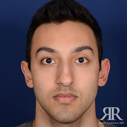 Ethnic Rhinoplasty