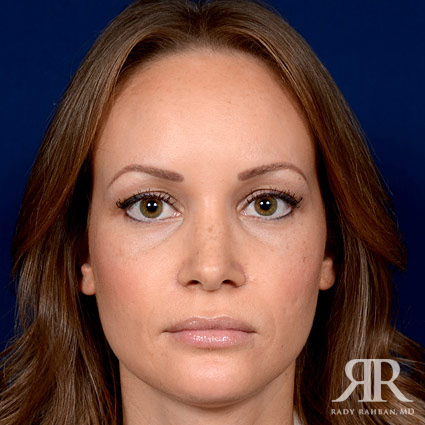 Woman that received rhinoplasty