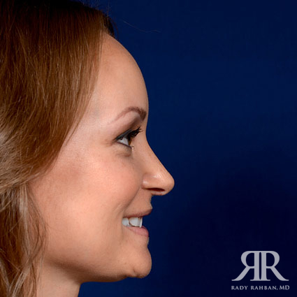 Female Rhinoplasty