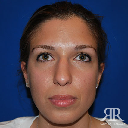 Female Rhinoplasty