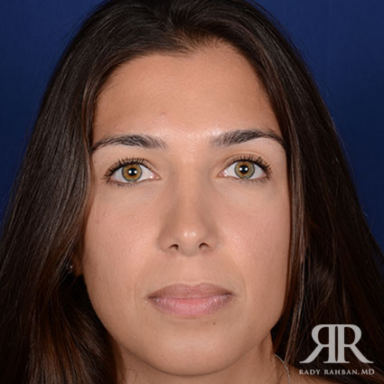 Woman pleased with her Rhinoplasty