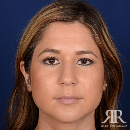 Female Rhinoplasty