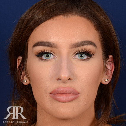 Female Rhinoplasty