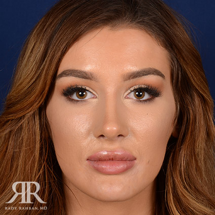 Female Rhinoplasty