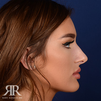 Female Rhinoplasty