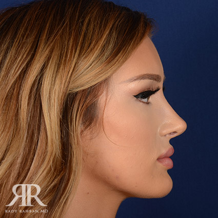 Female Rhinoplasty