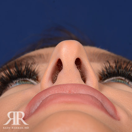 Female Rhinoplasty