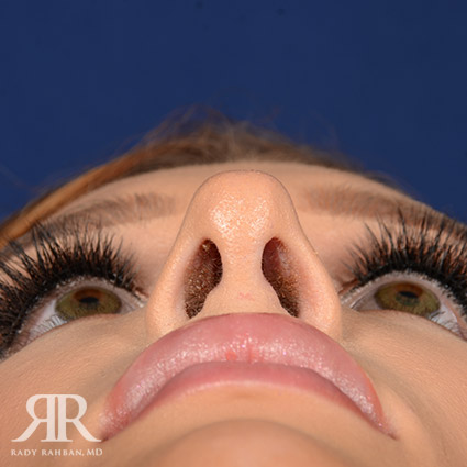 Female Rhinoplasty