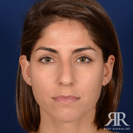 Female Rhinoplasty