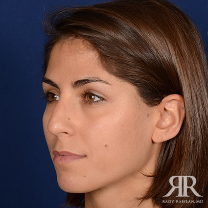 Female Rhinoplasty