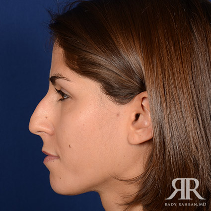 Female Rhinoplasty