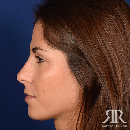 Female Rhinoplasty