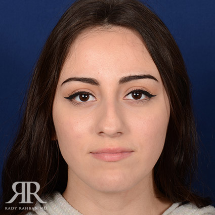 Female Rhinoplasty