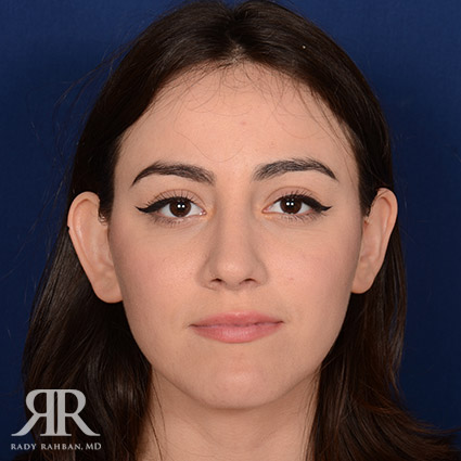 Female Rhinoplasty