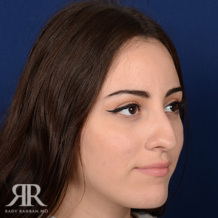 Female Rhinoplasty