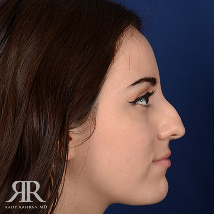 Female Rhinoplasty