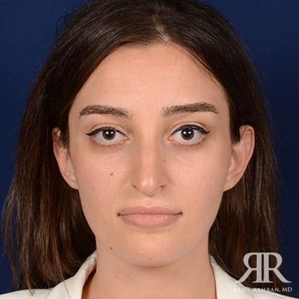 Female Rhinoplasty