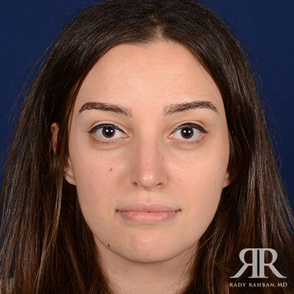 Female Rhinoplasty