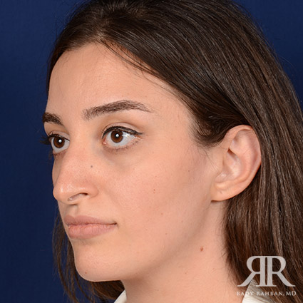 Female Rhinoplasty