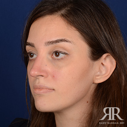 Female Rhinoplasty