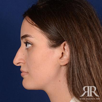 Female Rhinoplasty