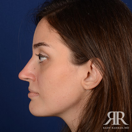 Female Rhinoplasty