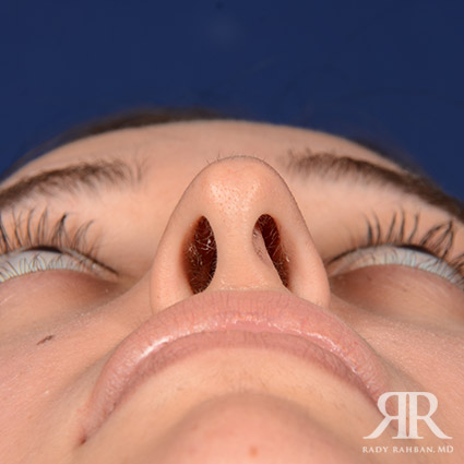 Female Rhinoplasty