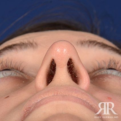 Female Rhinoplasty