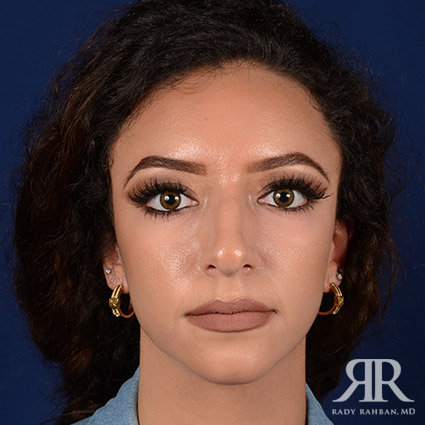 Female Rhinoplasty