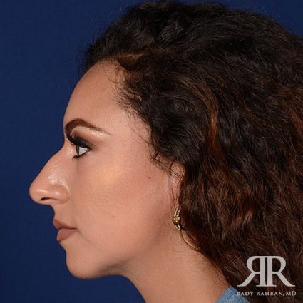 Female Rhinoplasty