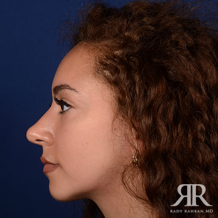 Female Rhinoplasty