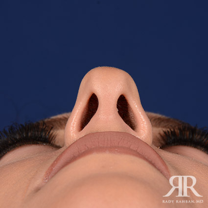 Female Rhinoplasty