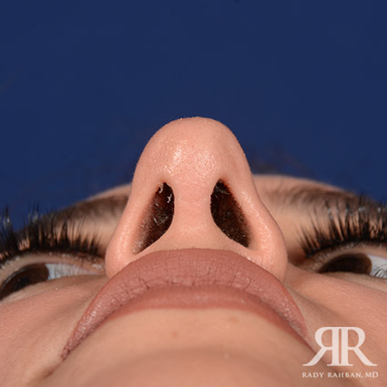 Female Rhinoplasty