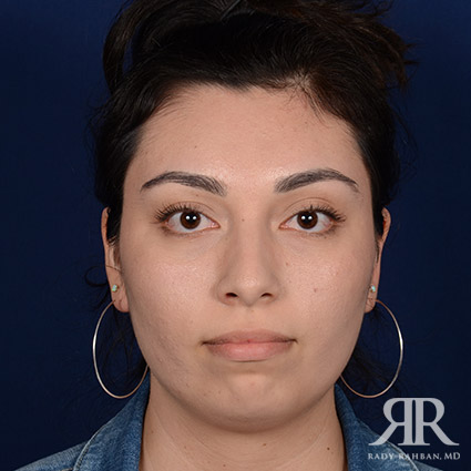 Female Rhinoplasty