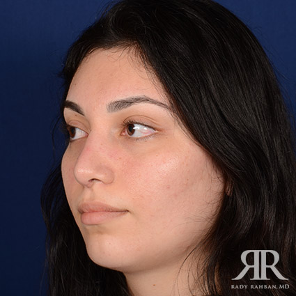 Female Rhinoplasty