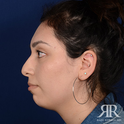 Female Rhinoplasty