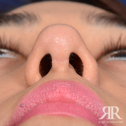 Female Rhinoplasty