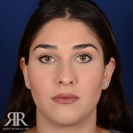 Female Rhinoplasty