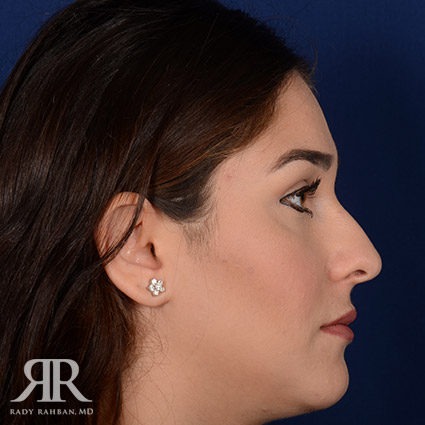 Female Rhinoplasty