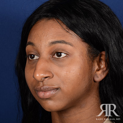 Female Rhinoplasty