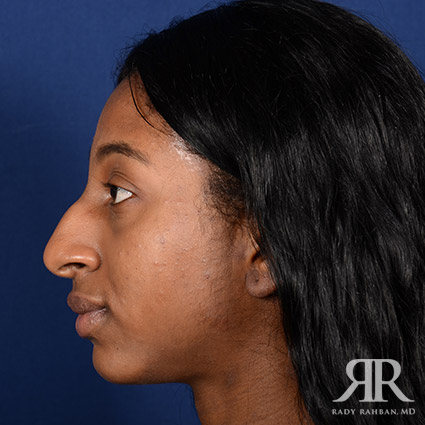 Female Rhinoplasty