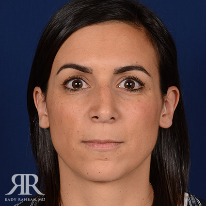 Female Rhinoplasty