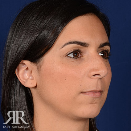 Female Rhinoplasty